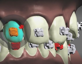 Ortodontia Inteligente 3D
