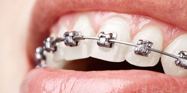 Porque você deve escolher a ortodontia autoligada com planejamento 3D
